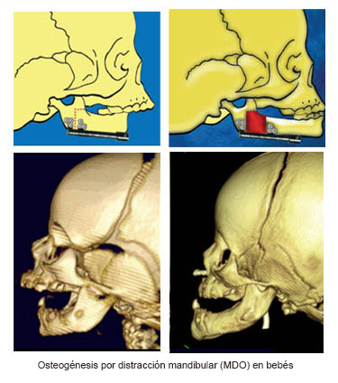 https://lilbundlebox.store/SiteCollectionImages/Infant_Mandibular_Distraction_Osteogenesis_es.jpg