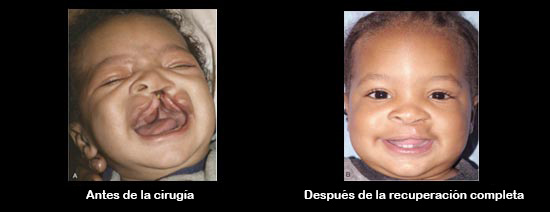 https://lilbundlebox.store/SiteCollectionImagesArticleImages/CleftbeforeAfter_Baby_es.jpg