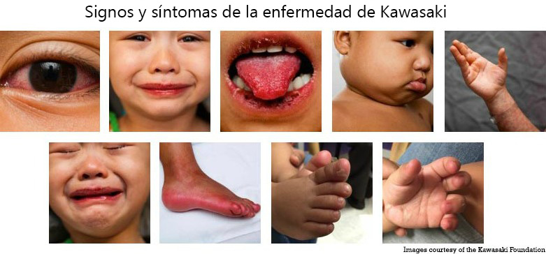 https://lilbundlebox.store/SiteCollectionImagesArticleImages/Signs_Symptoms_Kawasaki_Disease_es.jpg