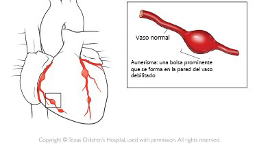 https://lilbundlebox.store/SiteCollectionImagesArticleImages/aneurysm_texaschildrens_es.jpg