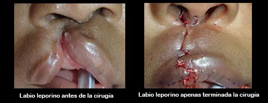 https://lilbundlebox.store/SiteCollectionImagesArticleImages/cleftLipBeforeAfter2_es.jpg
